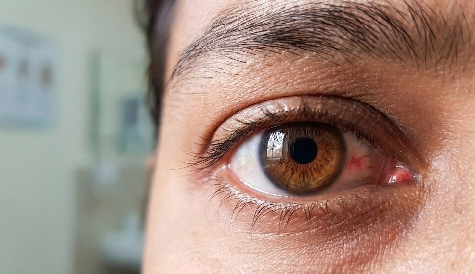 Diabetic Retinopathy